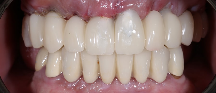 Εμφυτεύματα Δοντιών