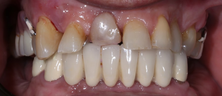 Εμφυτεύματα Δοντιών