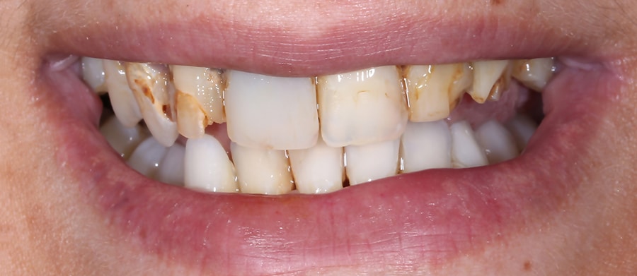 Στεφάνες - Θήκες Δοντιών