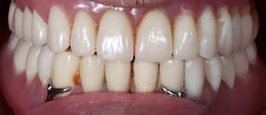 Εμφυτεύματα Δοντιών