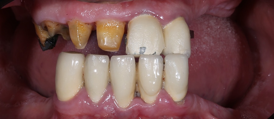 Εμφυτεύματα Δοντιών