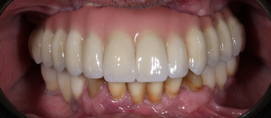 Εμφυτεύματα Δοντιών