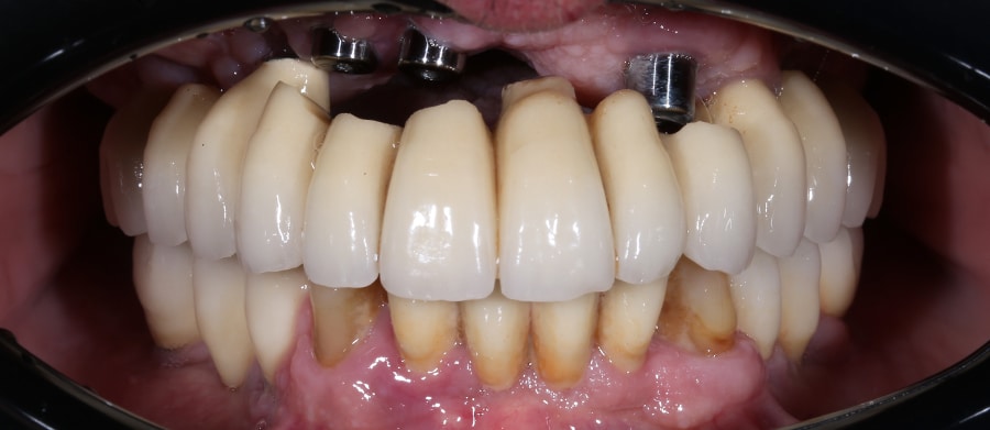 Εμφυτεύματα Δοντιών