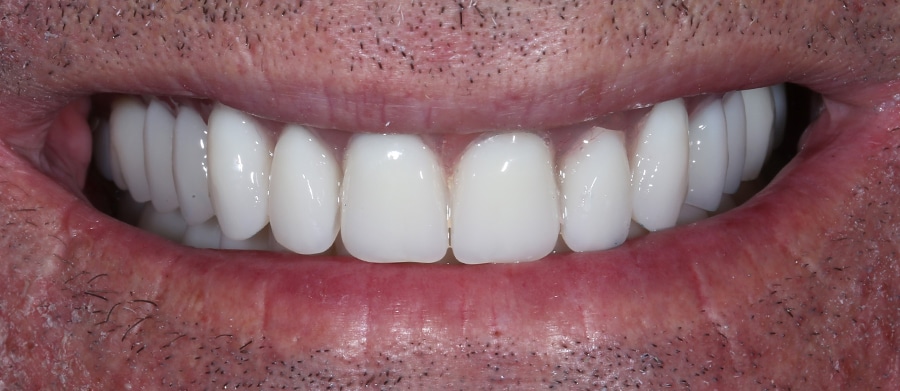 Εμφυτεύματα Δοντιών