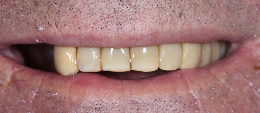 Εμφυτεύματα Δοντιών