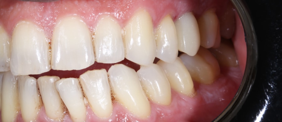 Εμφυτεύματα Δοντιών