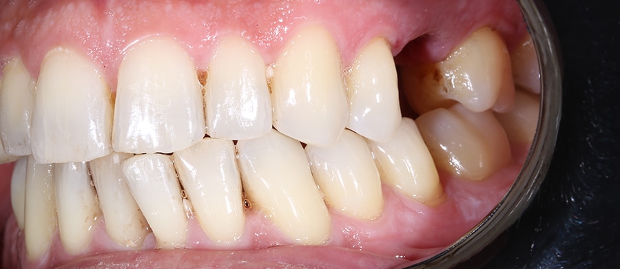 Εμφυτεύματα Δοντιών