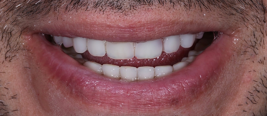 Εμφυτεύματα Δοντιών