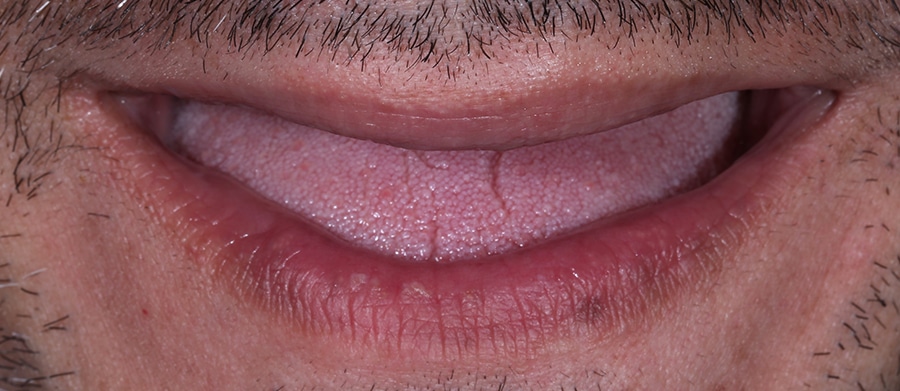 Εμφυτεύματα Δοντιών