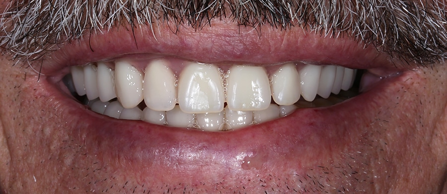 Εμφυτεύματα Δοντιών