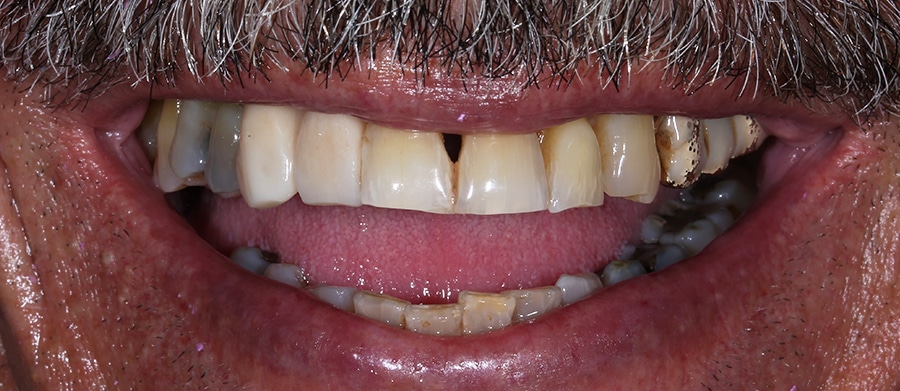 Εμφυτεύματα Δοντιών