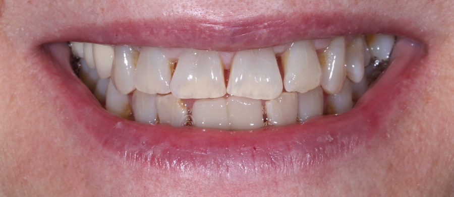 Εμφυτεύματα Δοντιών