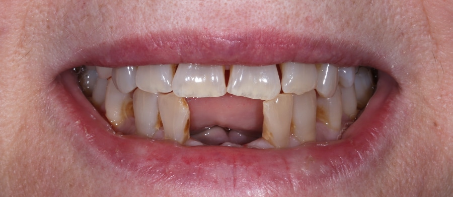 Εμφυτεύματα Δοντιών