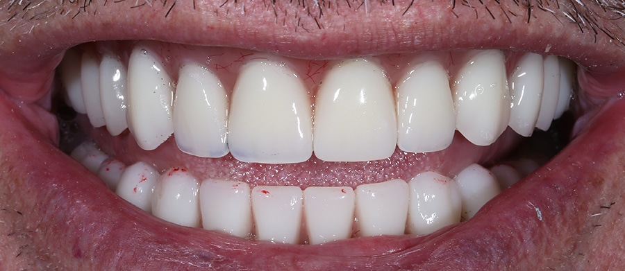 Εμφυτεύματα Δοντιών