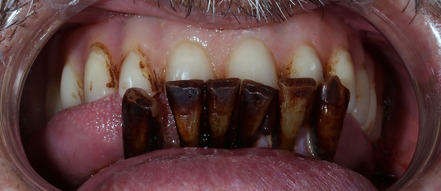 Εμφυτεύματα Δοντιών