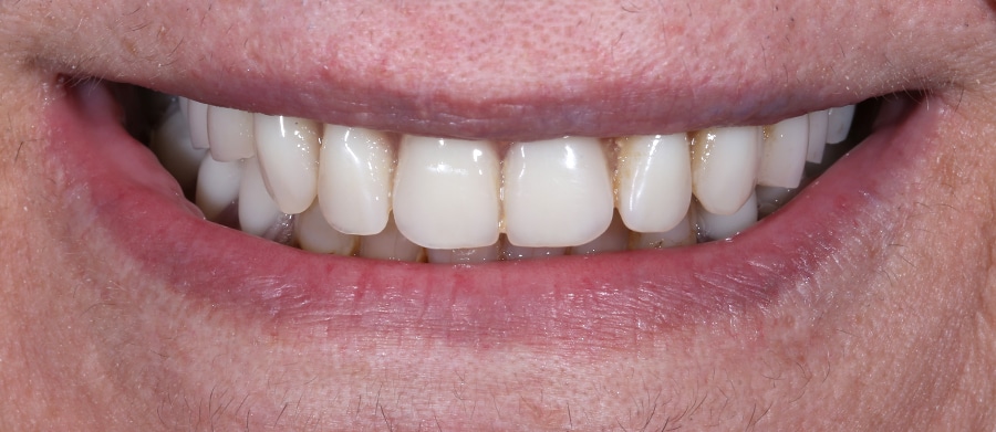 Εμφυτεύματα Δοντιών