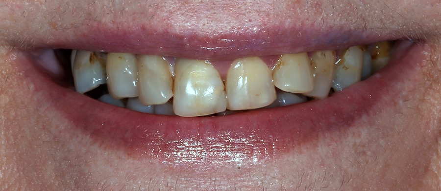 Εμφυτεύματα Δοντιών