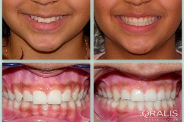 Ορθοδοντική Παίδων & Εφήβων