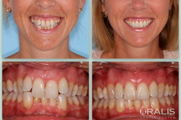 Ορθοδοντική Ενηλίκων