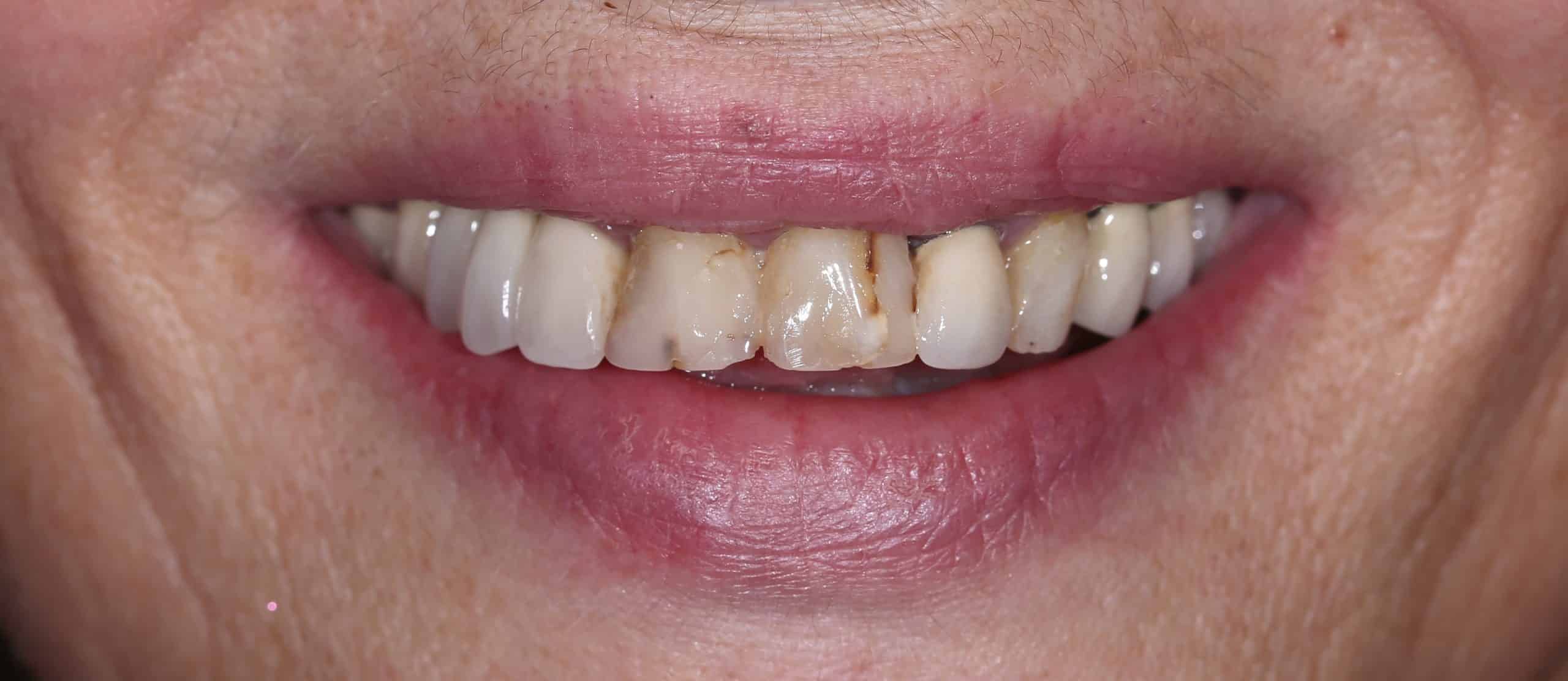 ΜΕΤΑΛΛΟΚΕΡΑΜΙΚΗ ΓΕΦΥΡΑ ΑΝΩ ΓΝΑΘΟΥ - ΠΡΙΝ