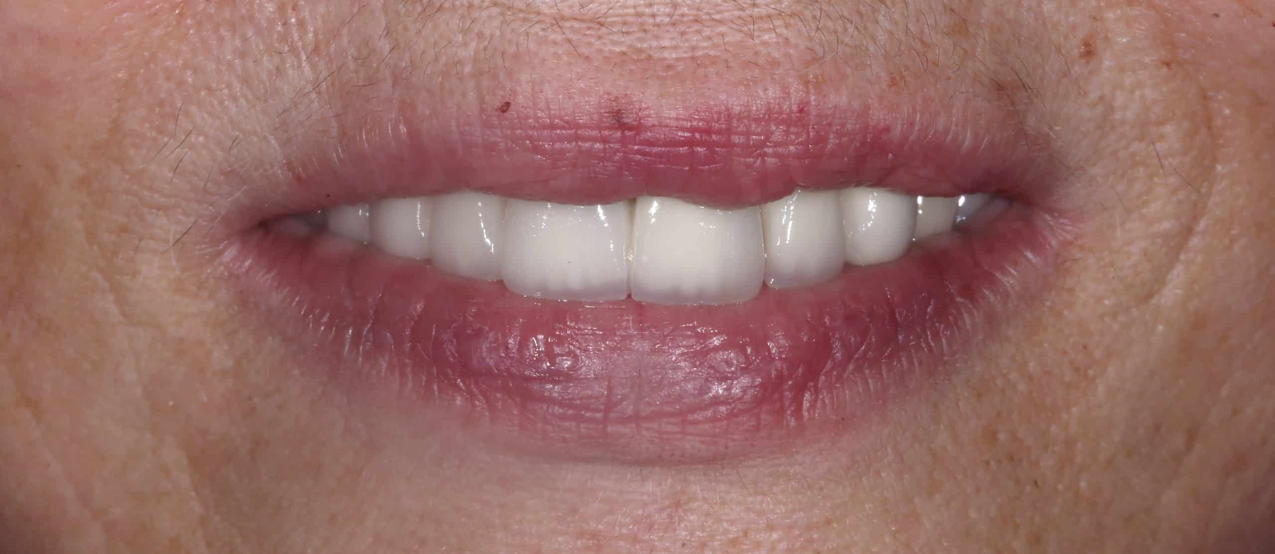 ΜΕΤΑΛΛΟΚΕΡΑΜΙΚΗ ΓΕΦΥΡΑ ΑΝΩ ΓΝΑΘΟΥ - ΜΕΤΑ