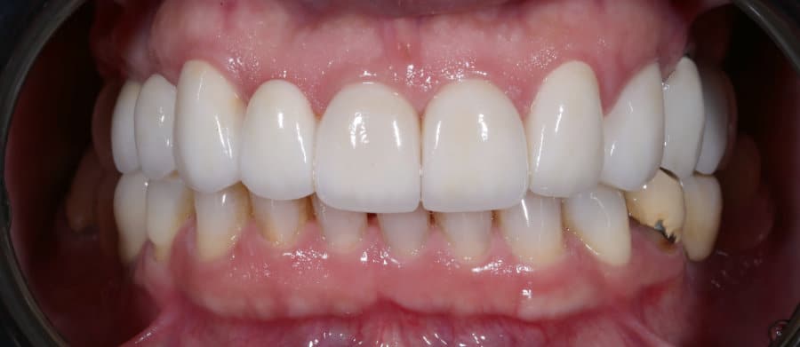 Ολοκεραμικές στεφάνες & εμφυτεύματα - Μετά