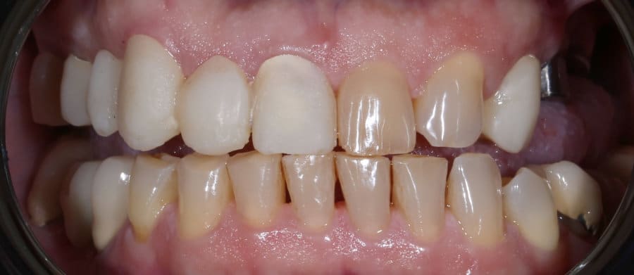 Ολοκεραμικές στεφάνες & εμφυτεύματα - Πριν