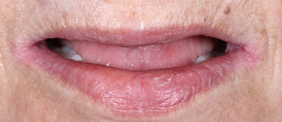 ΕΠΕΝΘΕΤΗ ΕΠΙΕΜΦΥΤΕΥΜΑΤΙΚΗ ΟΔΟΝΤΟΣΤΟΙΧΙΑ-ΠΡΙΝ