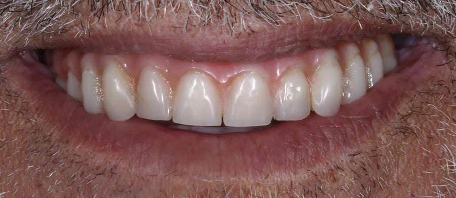 ΑΜΕΣΗ ΦΟΡΤΙΣΗ ΑΝΩ ΚΑΙ ΚΑΤΩ ΓΝΑΘΟΥ - ΜΕΤΑ