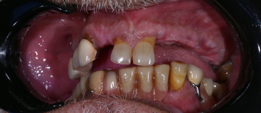 ΑΜΕΣΗ ΦΟΡΤΙΣΗ ΑΝΩ ΚΑΙ ΚΑΤΩ ΓΝΑΘΟΥ - ΠΡΙΝ