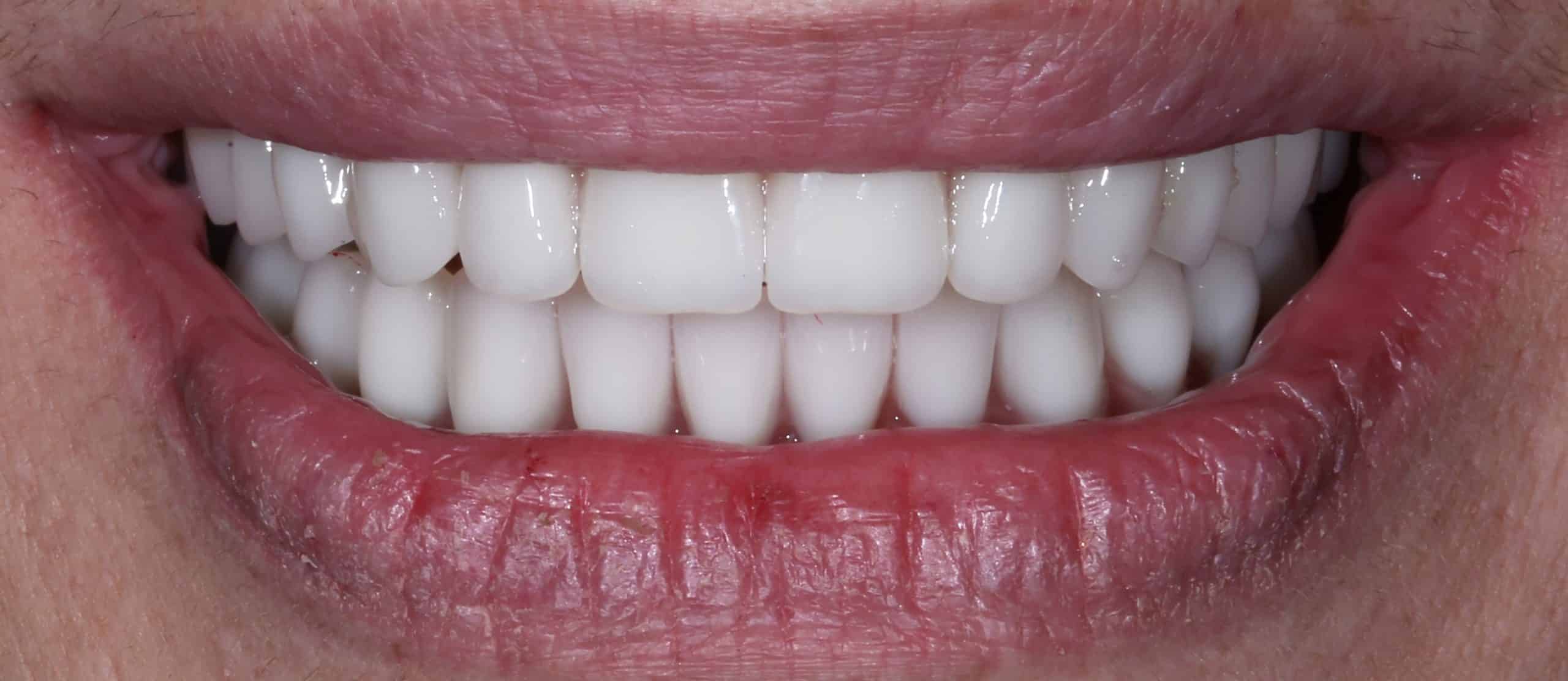 ΑΜΕΣΗ ΦΟΡΤΙΣΗ - ΜΕΤΑ