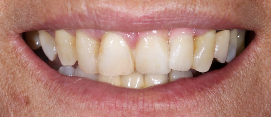 ΜΕΤΑΛΛΟΚΕΡΑΜΙΚΗ ΓΕΦΥΡΑ ΕΠΙ ΕΜΦΥΤΕΥΜΑΤΩΝ-ΜΕΤΑ