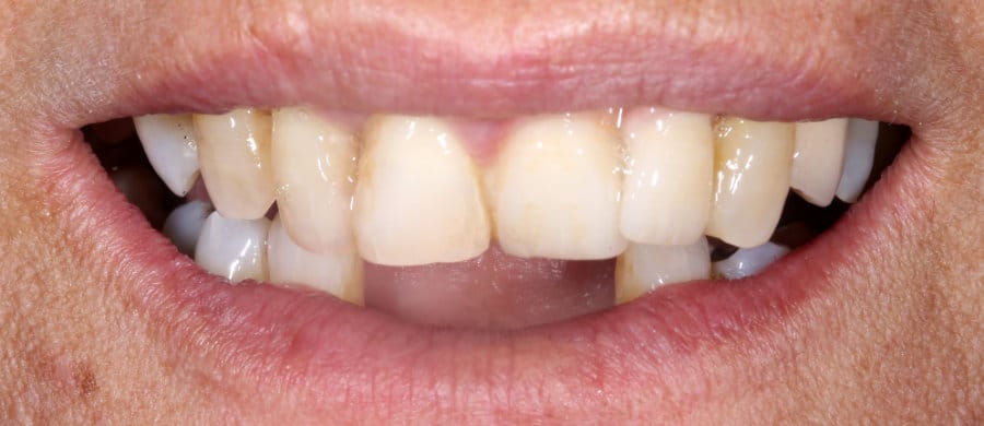 ΜΕΤΑΛΛΟΚΕΡΑΜΙΚΗ ΓΕΦΥΡΑ ΕΠΙ ΕΜΦΥΤΕΥΜΑΤΩΝ-ΠΡΙΝ