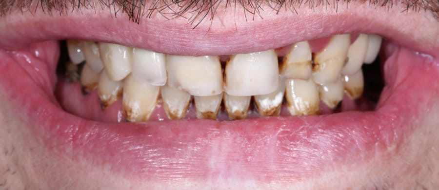 Στεφάνες ζιργκονίου - πριν