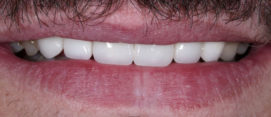 Στεφάνες ζιργκονίου - μετά