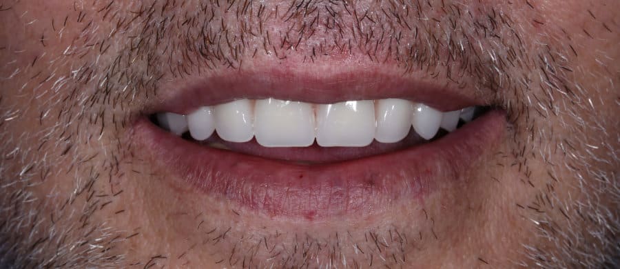 Επένθετη οδοντοστοιχία επι εμφυτευμάτων - μετά