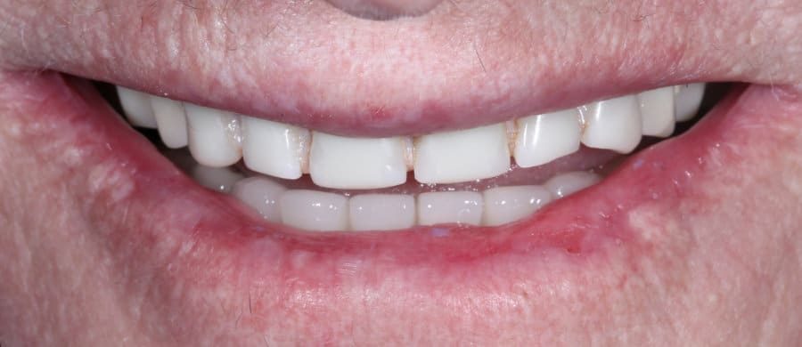 Επιεμφυτευματική αποκατάσταση άνω γνάθου - πριν