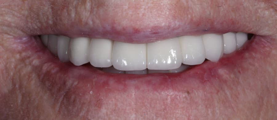 Επιεμφυτευματική αποκατάσταση άνω γνάθου - μετά