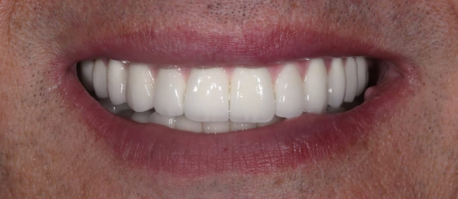 Μεταλλοκεραμική γέφυρα επί εμφυτευμάτων - μετά