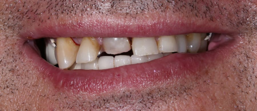 Μεταλλοκεραμική γέφυρα επί εμφυτευμάτων - πριν