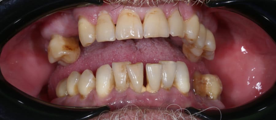 ΑΜΕΣΗ ΦΟΡΤΙΣΗ ΑΝΩ ΚΑΙ ΚΑΤΩ ΓΝΑΘΟΥ - ΠΡΙΝ