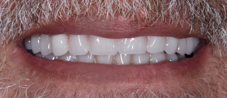 ΑΜΕΣΗ ΦΟΡΤΙΣΗ ΑΝΩ ΚΑΙ ΚΑΤΩ ΓΝΑΘΟΥ - ΜΕΤΑ