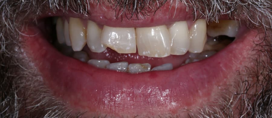 Όψεις πορσελάνης - πριν