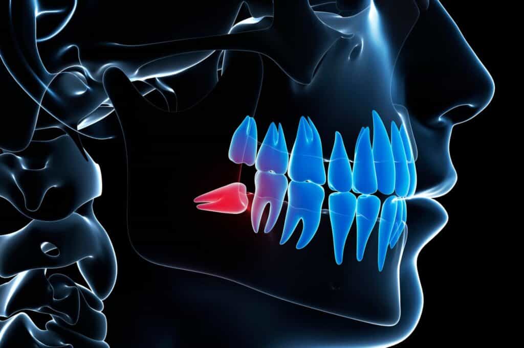 Φρονιμίτης: Συμπτώματα, Πόνος & Αφαίρεση | Όλα όσα πρέπει να ξέρετε φρονιμίτης