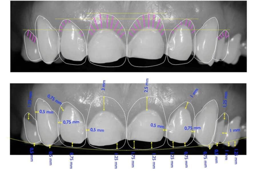 3D Σχεδιασμός Χαμόγελου