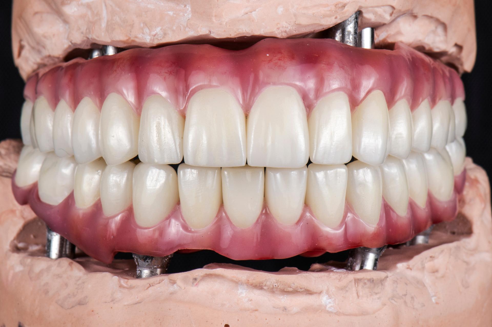 Αναγέννηση Οστού: Η Αναγέννηση των Χαμένων Περιοδοντικών Ιστών με Ελεγχόμενο Τρόπο