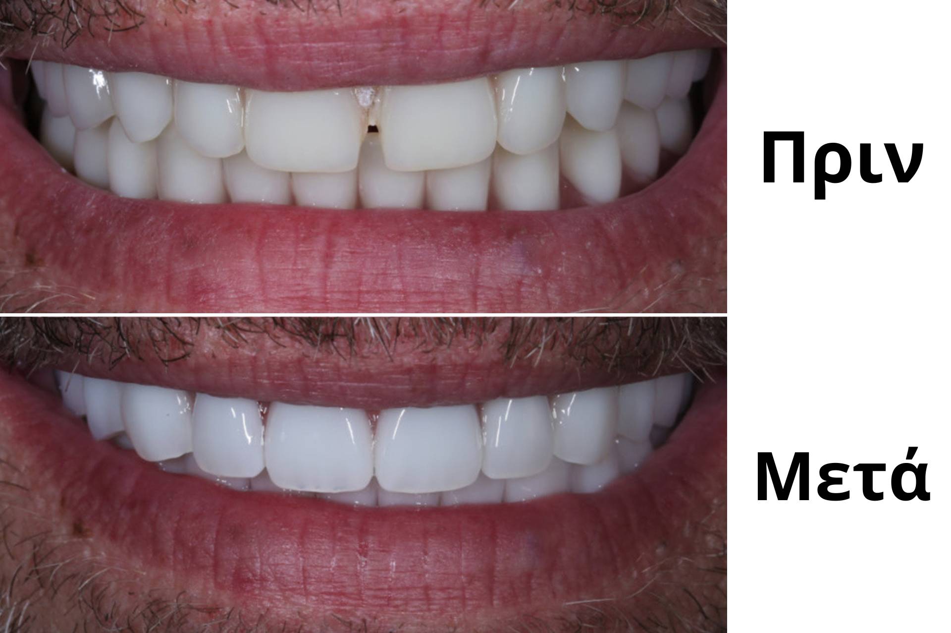 Επιπλοκές στα Εμφυτεύματα Δοντιών 1