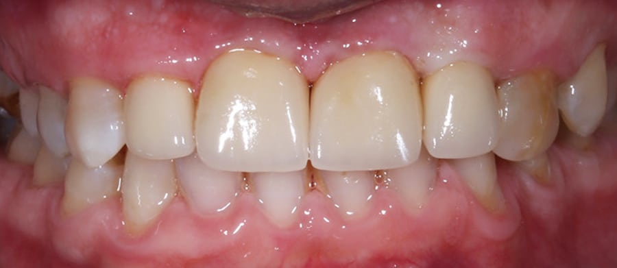 Λαμπερό Χαμόγελο με Θήκες Πορσελάνης 2α