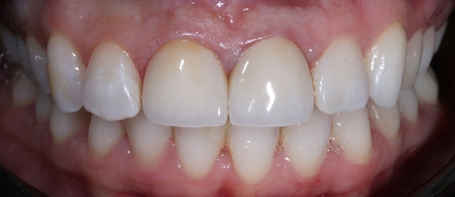 Λαμπερό Χαμόγελο με Θήκες Πορσελάνης 2β