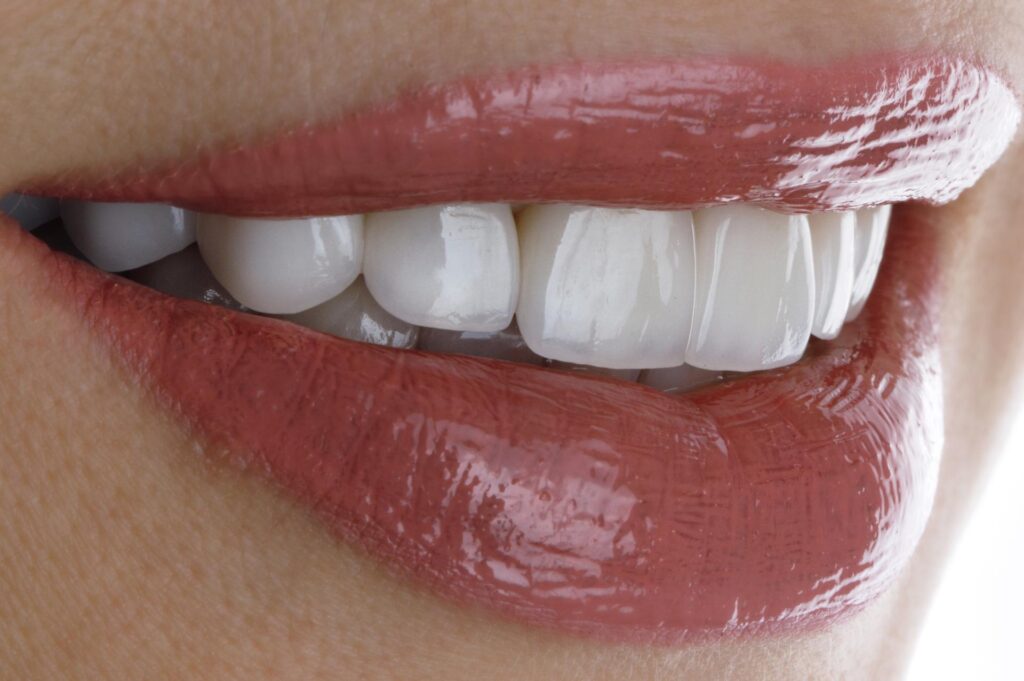 Όψεις Πορσελάνης Λαμπερό Χαμόγελο με Θήκες Πορσελάνης